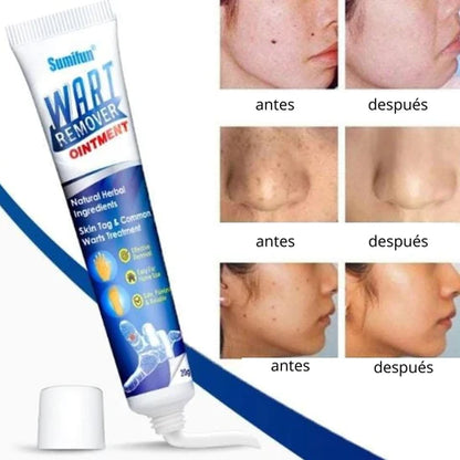Kit removedor de verrugas: Crema + jabón limpiador